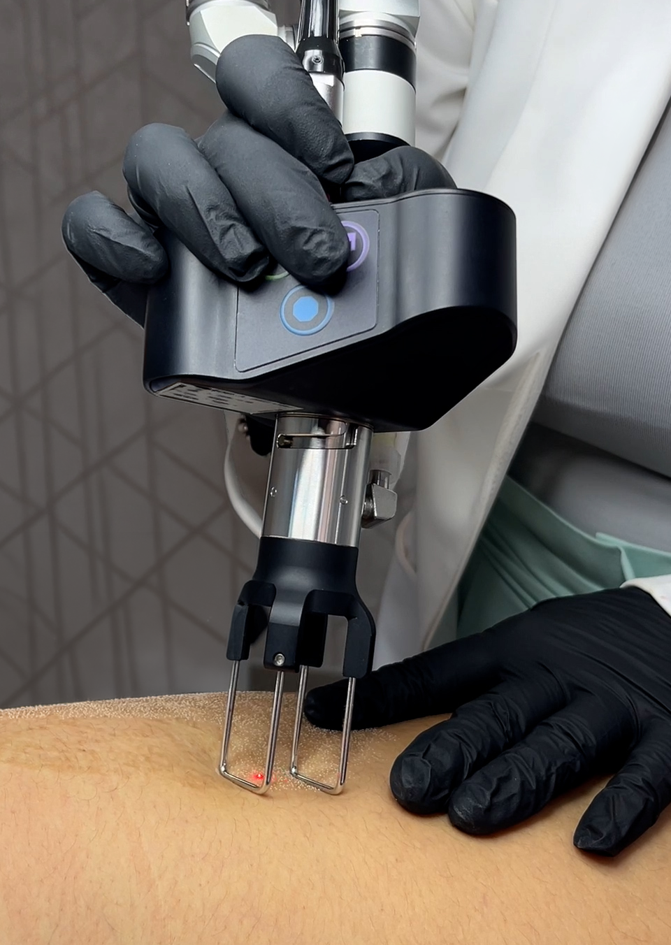 Láser CO2 Fraccionado